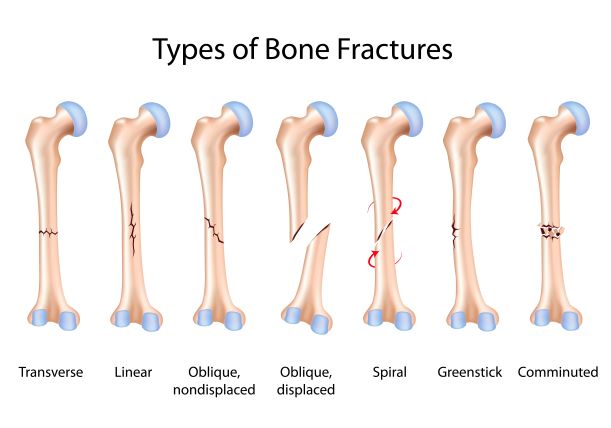 Types of Fractures.Resized 1